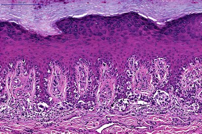 Melanoma acral não pode ser prevenido com filtro solar