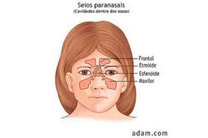  Sinusite em crianças: sintomas, causas e tratamento