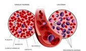 Autorizada pesquisa em pacientes com leucemia linfoide aguda B