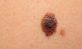 Melanoma responde por 4 entre 10 mortes, alertam especialistas