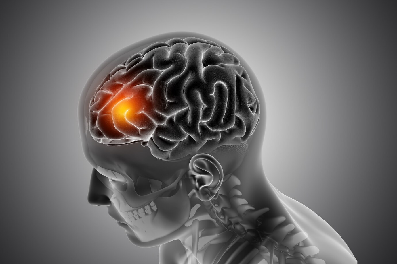 Neurologista explica sobre aumento de casos de AVC