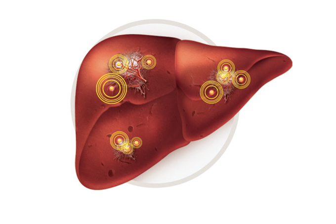 Silenciosas, hepatites B e C são as principais causas do câncer do fígado