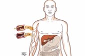 Tratamento: veja como identificar e prevenir o colesterol alto